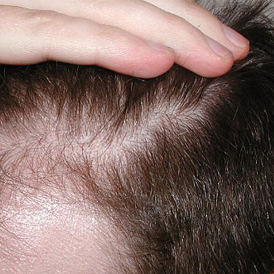 Dermatologia- alopecia e diradamento