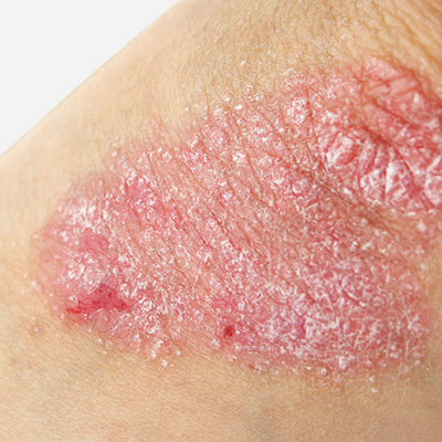 dermatologia - psoriasi ed eczemi